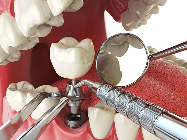 Best Emergency Dental Care for Broken or Chipped Teeth in Anchor Point, AK